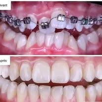 Orthodontie - Cas 3